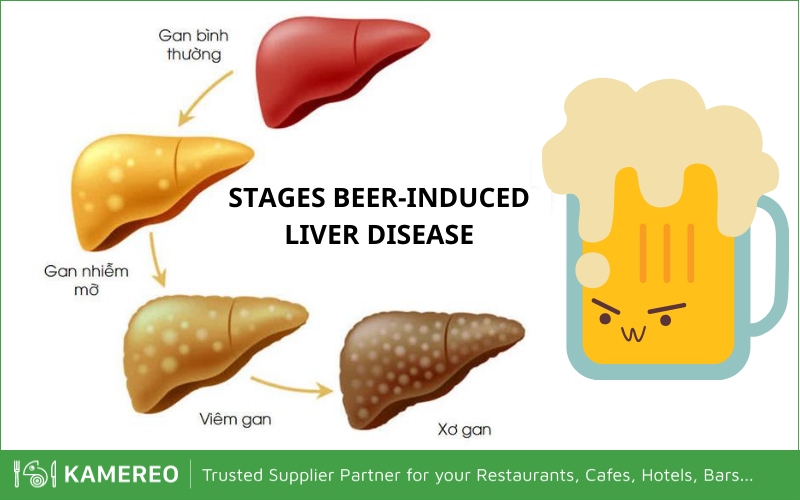 Beer is the main cause of cirrhosis