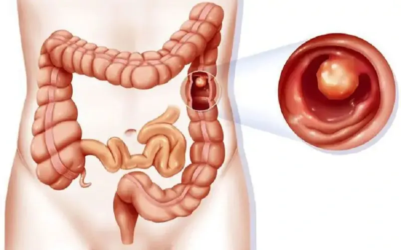 Eating foods fried multiple times increases the risk of colorectal cancer